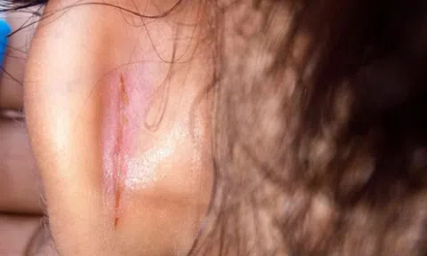 Tạm đình chỉ cô giáo kéo rách tai học sinh lớp 1